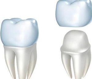 cost effective CEREC Crown from dentist in Glen Allen VA