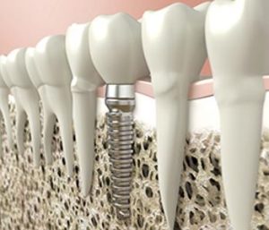 Best dental implants for missing teeth from expert dentist in Glen Allen