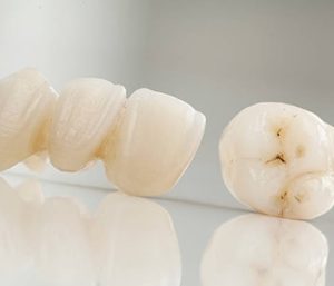 Same Day Crowns Near Me Glen Allen