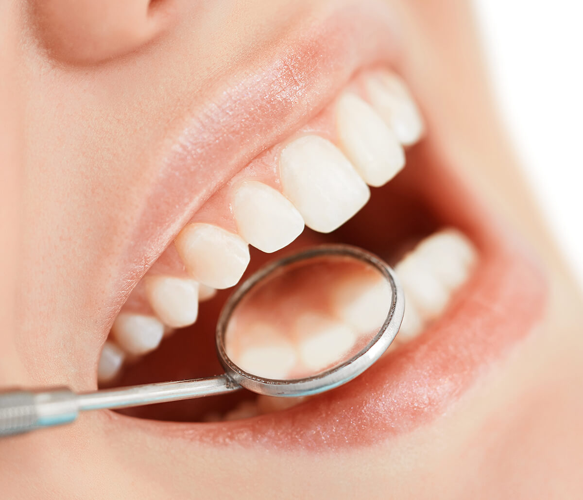 BPA Free Composite Resin Fillings in Richmond VA area