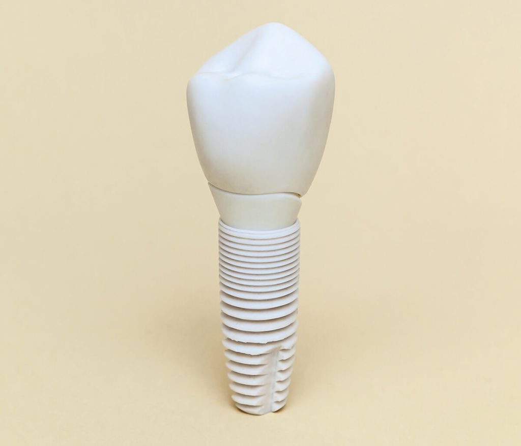 Metal Free Dental Implants in Glen Allen VA Area