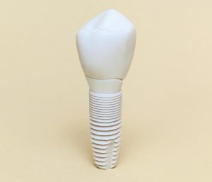 Metal Free Dental Implants in Glen Allen VA Area